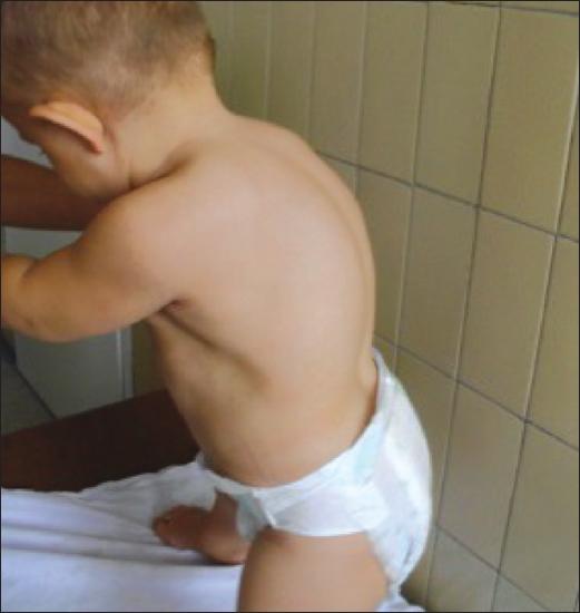 Clinical photograph of the boy: thoracic kyphosis.
