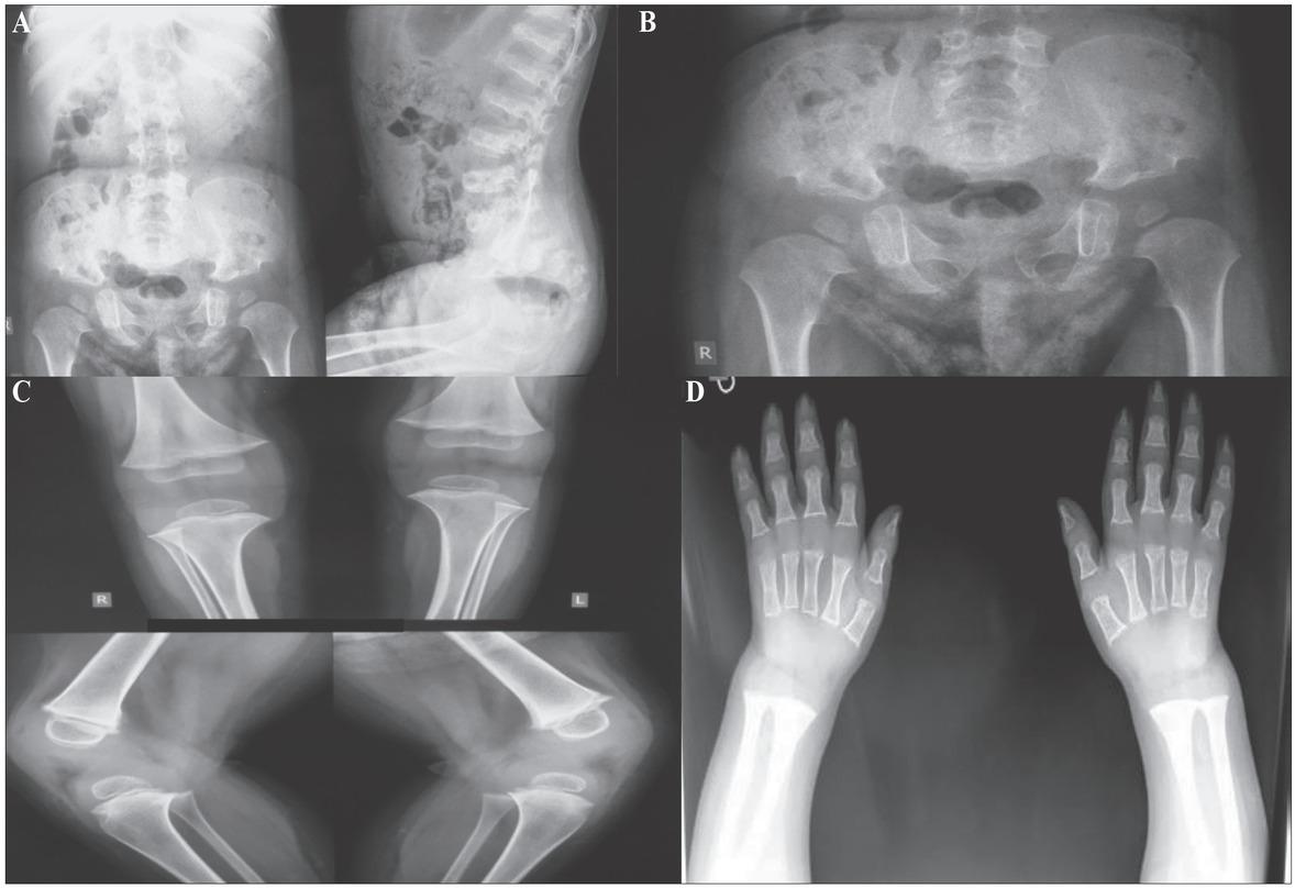 A) AP spine showing platyspondyly. Lateral spine showing kyphosis, narrow chest. The ribs are narrow posteriorly, but widened and irregular anteriorly and markedly sclerotic. There is a gibbous deformity. B) Short sacro-iliac notches. Hypoplasia of the bodies of iliac bones. The shape of the iliac bone is unique, a notch between the shortened iliac body and prominent crescent shaped iliac wing resembles a halberd. Shortened tubular bones with flared metaphyses. C) The chondroosseous junction is smooth at the knee, but there are cartilaginous remnants in the distal femora. Carpal ossification is significantly retarded. D) The middle and distal phalanges are short. Degenerative joint disease is found in the proximal interphalangeal joints. Hypoplastic/dysplastic carpal bones. Short metacarpals and phalanges with flared ends.
