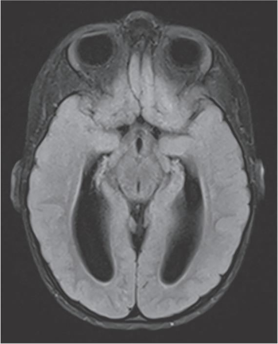FLAIR transverse brain MRI (13 months) showed internal hydrocephalus and spots of impaired mye-lination.