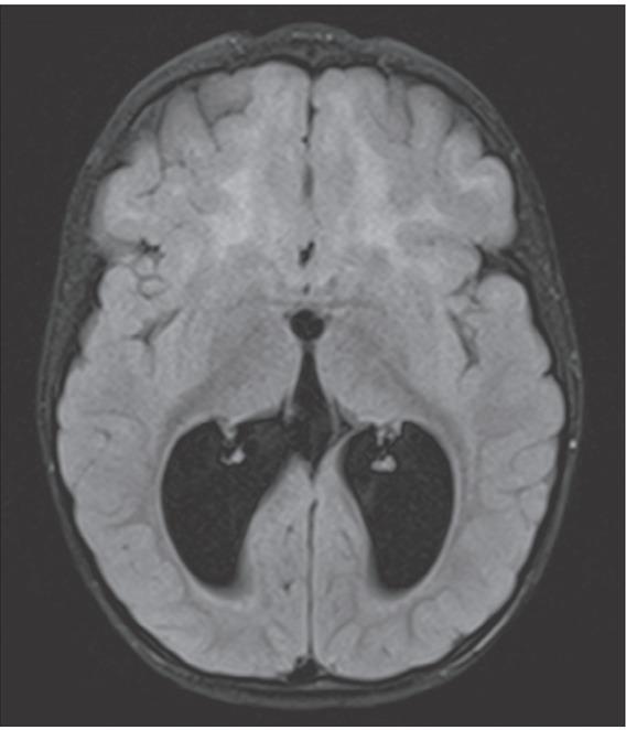 FLAIR transverse brain MRI (13 months) revealed ventriculomegaly with disturbed myelination: diffuse hyperintensity of white matter in the frontal lobe, within the left lentiform nucleus and in the left-sided posterior part of the internal capsule.