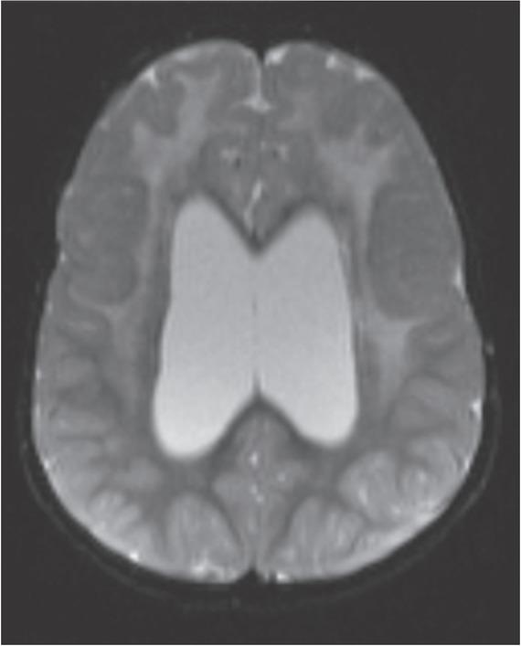 SET2 weighted transverse brain MRI (13 months) with areas of diffuse hyperintensity of white matter in the frontal lobe, within the left lentiform nucleus and in the left-sided part of the internal capsule.