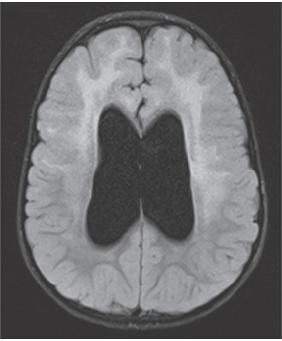 DICOMDIR (18 months) showed internal hydrocephalus and improper myelination compared with the previous brain MRI performed at the age of 13 months.