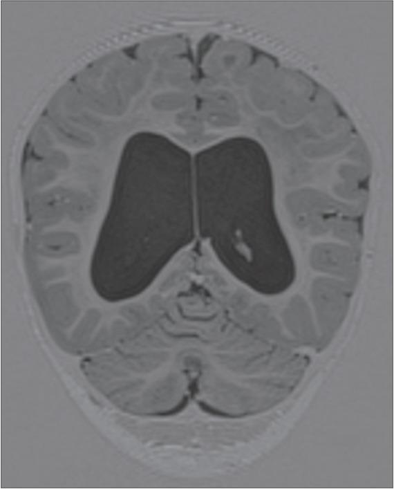 FLAIR transverse brain MRI (18 months) revealed internal hydrocephalus, the size of the lateral ventricles was comparable with the previous brain MRI result at the age of 13 months.