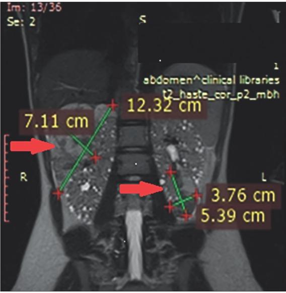 At the upper pole of the right kidney a large AML, longest diameter of 12.3 × 7.1 cm (arrow left) with heterogenous density, presence of microaneurisms at the posterior and lateral segments, with a dominant lipid component revealed on the urinary tract MRI (red arrow). At the lower pole of the left kidney, an AML with the dimension of 5.3 × 3.7 cm (arrow right) and other multiple AMLs with dimensions of 5-10 mm were found, as well as multiple cysts.