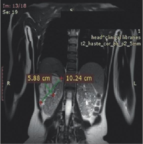 On the brain MRI, multiple lesions as subependimal nodules, subcortical tubers and largest tumor mass presented in foramen Monro as SEGA (diameter 3.0 × 1.5 cm) were described.