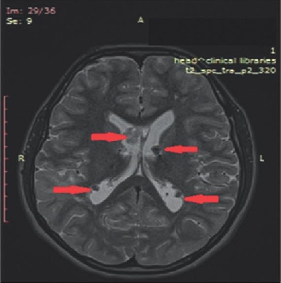 Magnetic resonance imaging of the urinary tract at 12 months after everolimus initiation.
