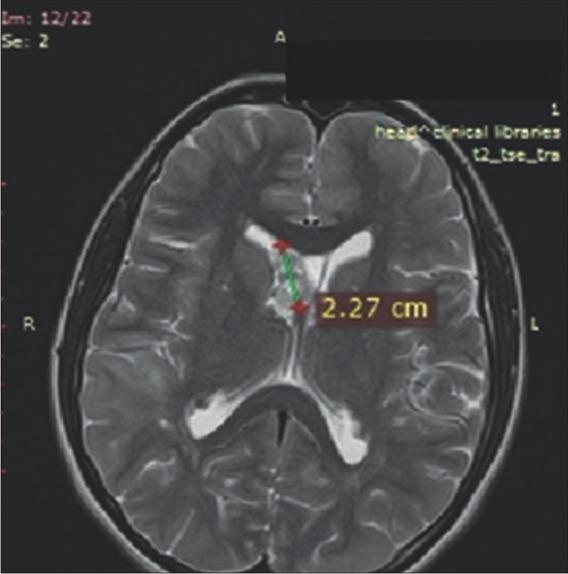 Magnetic resonance imaging of the brain at 12 months after everolimus initiation.