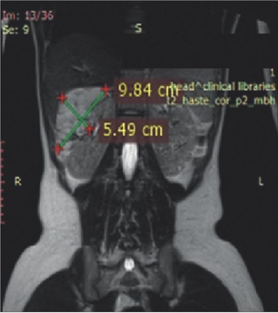Magnetic resonance imaging of the urinary tract at 36 months after everolimus treatment initiation.