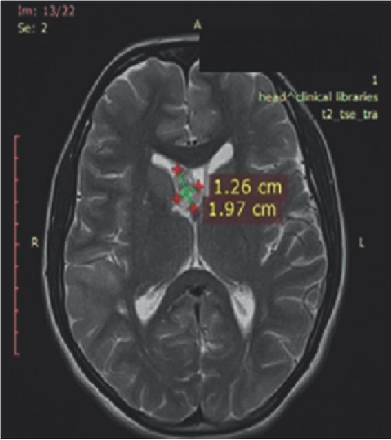 Magnetic resonance imaging of the brain at 36 months after everolimus treatment initiation.
