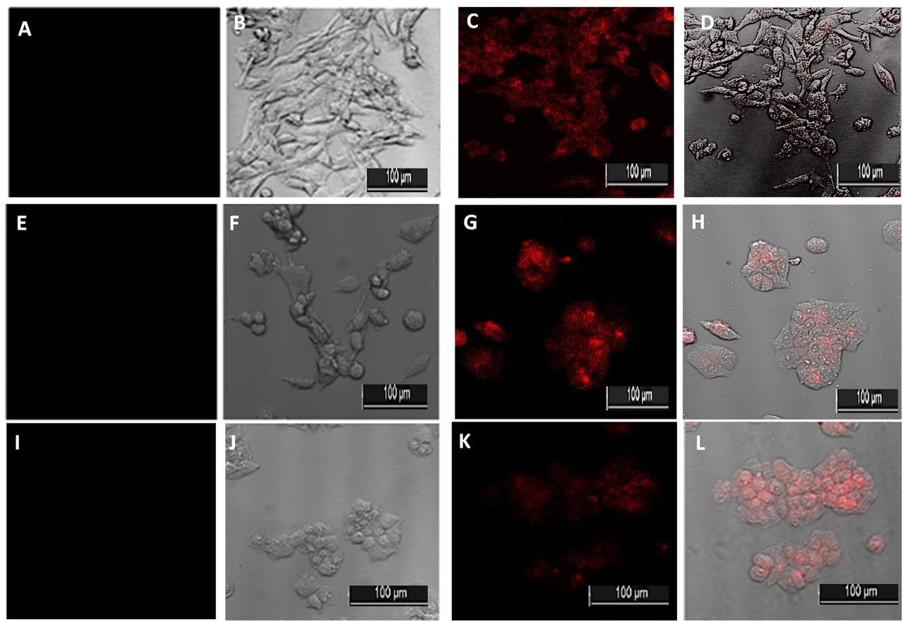 Intracellular fluorescent (PpIX) accumulation induced by ALA treatment observed after PBS washes, (40X-oil, 512x512). A) UMUC-3 cells non-ALA treated, observed by confocal microscope with standard detector-SD; B) UMUC-3 cells non-ALA treated, observed in white field by transmitted detector-TD; C) ALA treated UMUC-3 cells, observed by confocal microscope with SD; D) ALA treated UMUC-3 cells observed by white field and confocal with SD and TD; E) SK-MEL-30 cells non-ALA treated, observed by confocal microscope with SD; F) SK-MEL-30 cells non-ALA treated, observed in white field by TD; G) ALA treated SK-MEL-30 cells, observed by confocal microscope with SD; H) ALA treated SK-MEL-30 cells observed by white field and confocal with SD and TD; I) MCF-7 cells non-ALA treated, observed by confocal microscope with SD; J) MCF-7 cells non-ALA treated, observed in white field by TD; K) ALA treated MCF-7 cells, observed by confocal microscope with SD; L) ALA treated MCF-7 cells, observed by white field and confocal with SD and TD. (Excitation: 405 nm; emission: 614 nm)