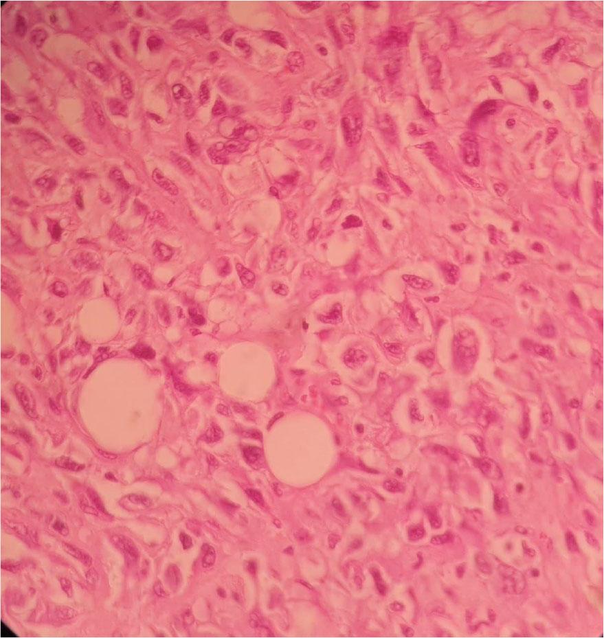 H&E stain shows bundles of atypical spindle cells (×10 power).