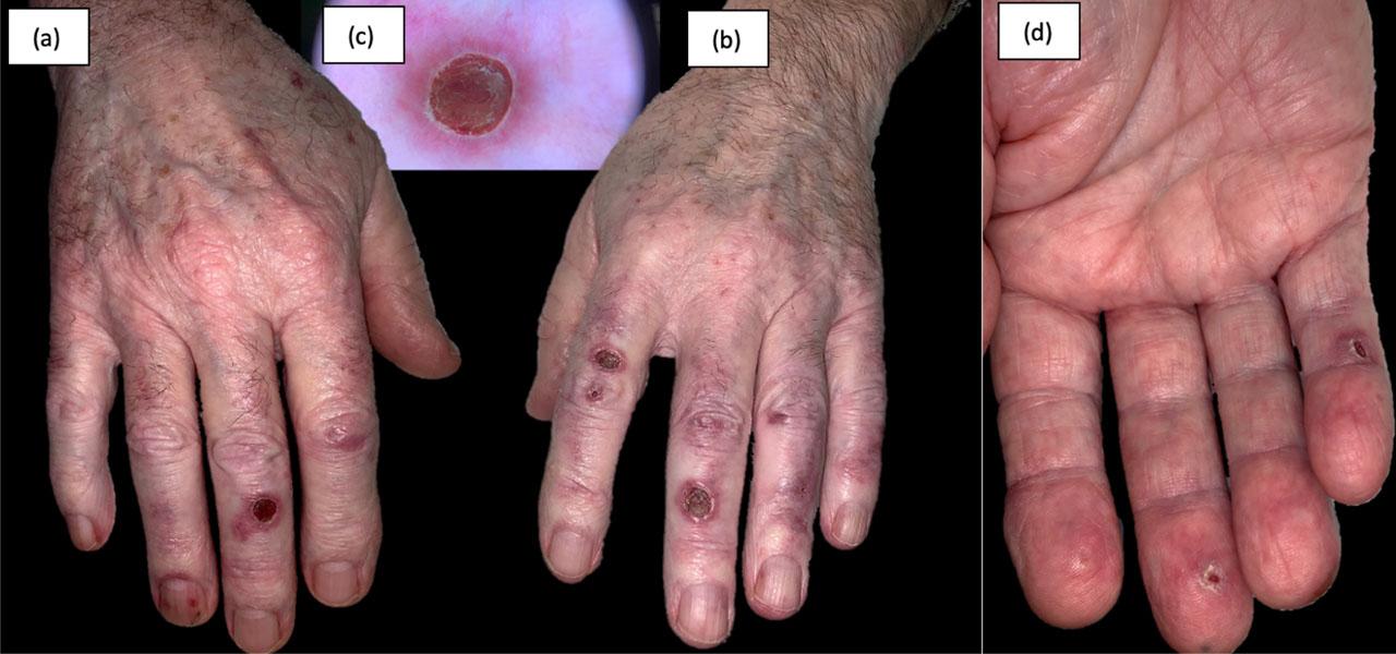 Lesions before discontinuation of hydroxyurea. (a and b) Numerous ulcers with well-defined borders located on the dorsum of the fingers can be seen. Also, appreciate the reddish hue on the back of the interphalangeal and metacarpophalangeal joints, creating a “pseudo-Gottron” pattern, like dermatomyositis. Nail brittleness and melanonychia are seen, features that are also widely described in urea toxicity. In (c), a dermatoscopic detail of the lesions can be seen, showing ulcers with very well-defined borders, with a whitish halo surrounded by another more erythematous one on the outside. The appearance of the ulcer is crusty and dry. (d) Shows detail of involvement in the palmar aspect.