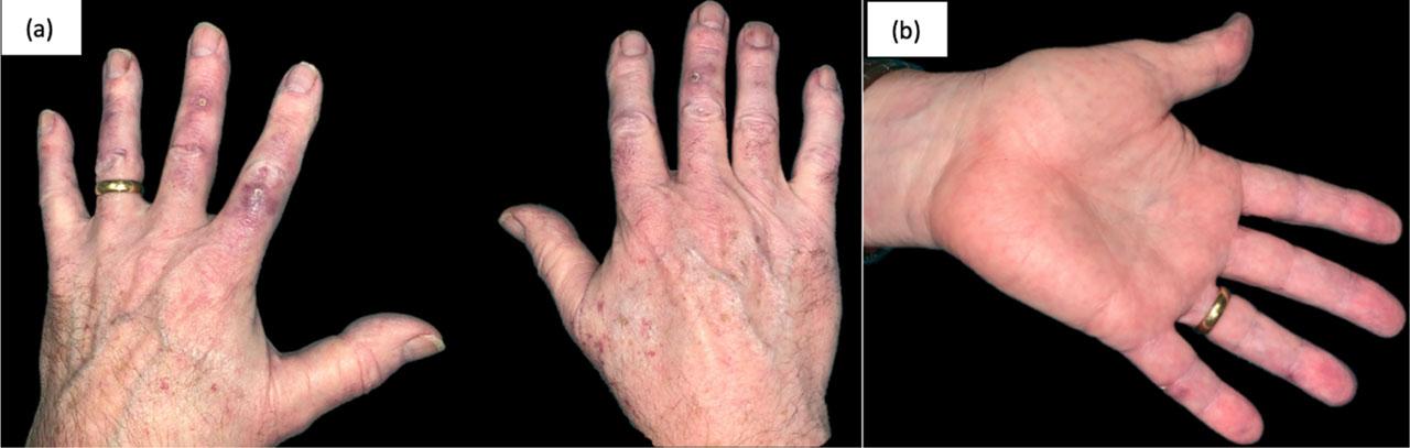 Lesions after discontinuation of hydroxyurea. One month after discontinuation of therapy, the patient showed a notable improvement in the lesions (a), in the case of smaller and clinically asymptomatic ulcers. In (b), improvement is also seen at the palmar level.