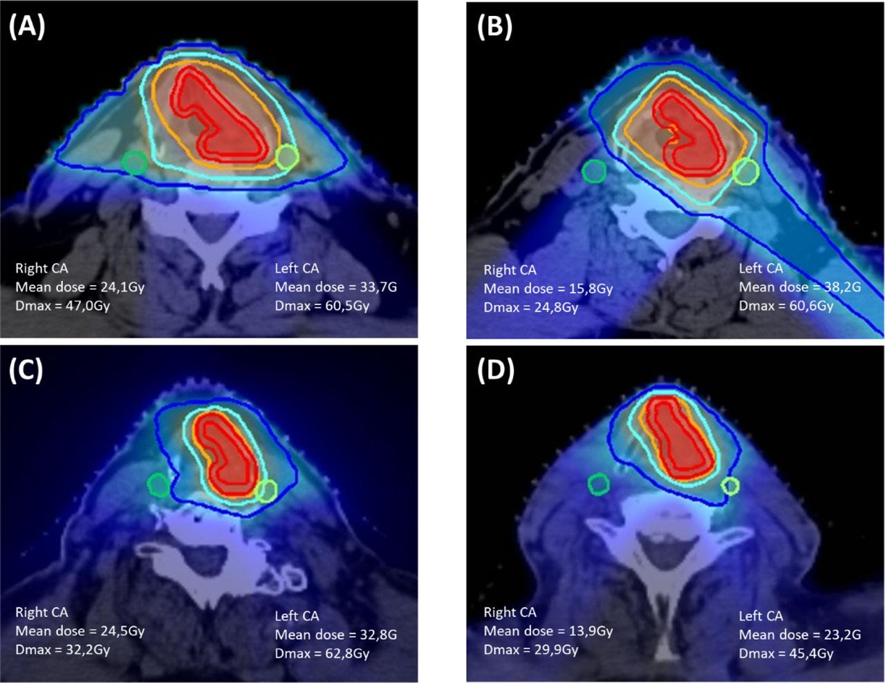 Dose distribution with prescribed isodose curves (50% in dark blue, 80% in light blue, and 95% in orange) for four patients with T1–2 left glottic squamous cell cancer, who underwent radical radiotherapy at a dose of 63–65.25 Gy in 28–29 fractions over 5.6–5.8 weeks. The red volumes represent the clinical target volume (CTV) and the planning target volume (PTV). Axial slices of representative cases were planned using (A) 3D-conformal radiotherapy with opposed lateral fields, (B) 3D-conformal radiotherapy with oblique beams, (C) helical tomotherapy-intensity-modulated radiotherapy, and (D) volumetric modulated arc therapy.