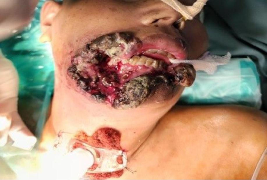 Oral cancer with fungating growth.