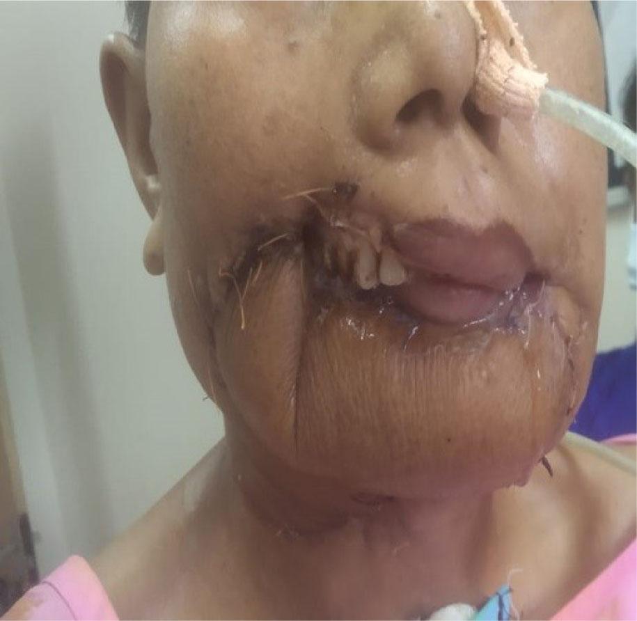 Fibula free flap POD 10.