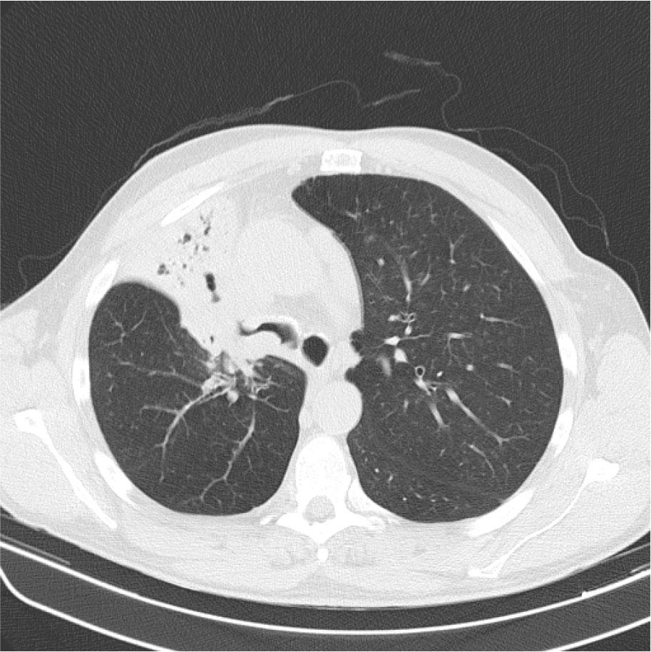 CT scan at diagnosis showing a right upper lobe lesion with right upper and medium lobes collapse.