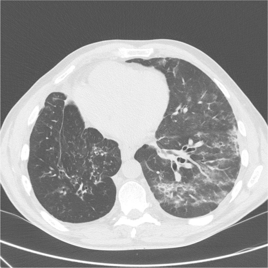 CT scan after treatment with amivantamab showing scattered ground glass opacities in the left lung.