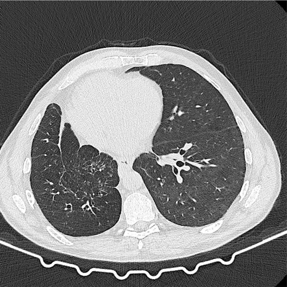 CT scan after corticosteroid treatment showing resolution of the previous opacities.