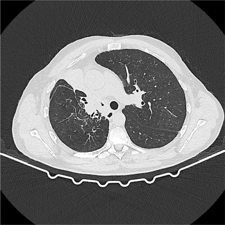 CT scan after reintroduction of amivantamab, without evidence of toxicity and stable disease.