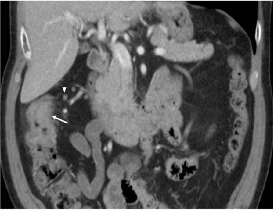 Circumferential thickening and heterogenous attenuation of the ascending colon just proximal to the level of the hepatic flexure.