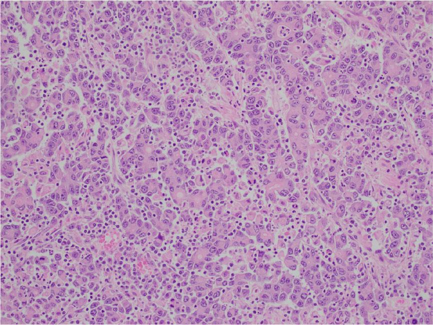Higher magnification reveals poorly differentiated cells with medium to large-sized vesicular nuclei, nucleoli, and moderate eosinophilic cytoplasm. The larger carcinomatous cells are interspersed by the smaller tumor infiltrating lymphocytes.