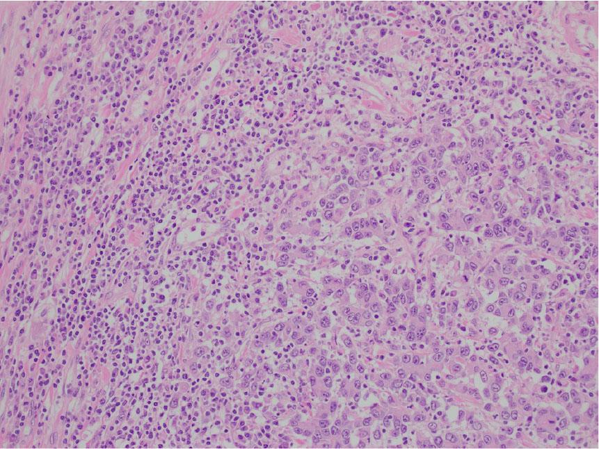 The medullary carcinoma is composed of poorly to undifferentiated cells in a vaguely trabecular to solid pattern. It lacks the typical glandular formation and mucin content seen in traditional colonic adenocarcinomas. The carcinoma has a circumscribed, pushing border, with a brisk intraepithelial and peritumoral lymphocytic infiltration.