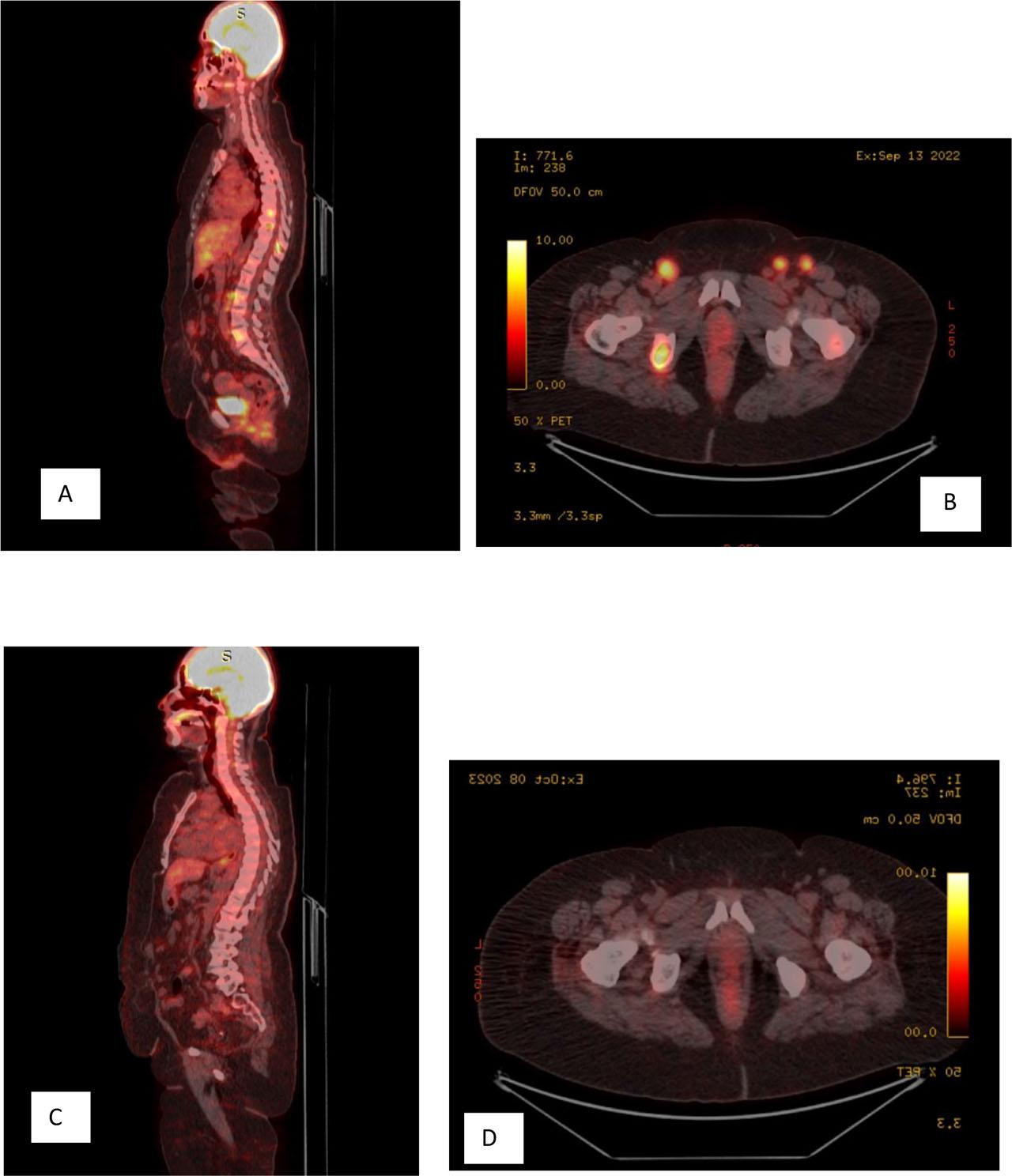 A and B: PET Scan before hormonal treatment, C and D: PET Scan after hormonal treatment.