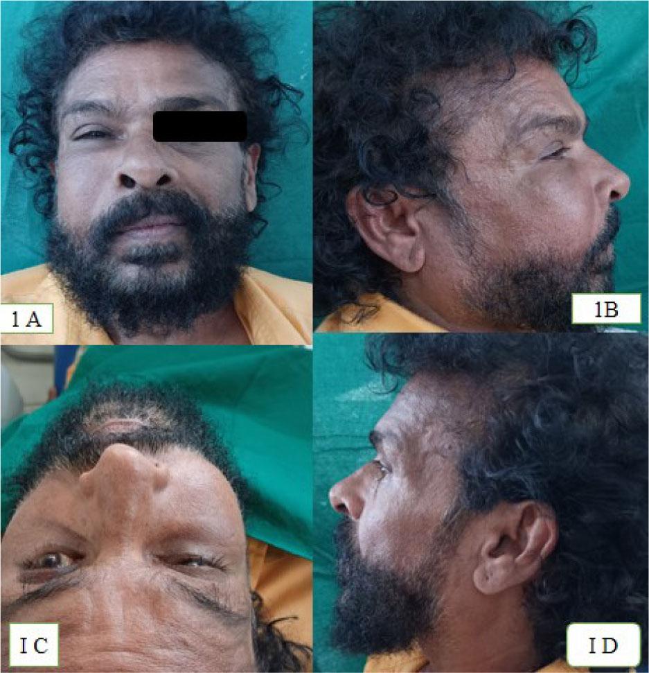 Extraoral swelling seen with respect to middle one third of right side of face. 1A and 1B: Extension of swelling involving the ala of nose medially, laterally along the vertical line drawn from outer canthus of eye, superiorly involving the infraorbital region with sunken eyes, and inferiorly along the horizontal line drawn from right commissure of lip. 1C: Bird’s view showing the swelling involving the infraorbital region with respect to right side with subsequent shrinking of right eye. 1D: Left profile view showing the normal appearance when compared to the right side.