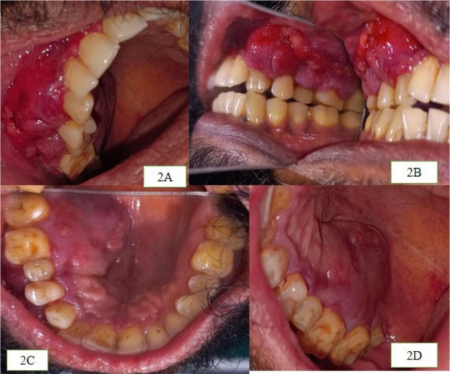 Intraoral swelling present with respect to vestibular region and palate. 2A and 2B: Proliferative vascular growth seen extending from the attached gingiva with respect to 12 to interdental space between 16 and 17 and superiorly involving the buccal vestibule 2C and 2D: Well-defined ovoid swelling seen extending from the interdental space between 15 and 16 was seen crossing the midline and posteriorly extending till the junction of hard and soft palate.