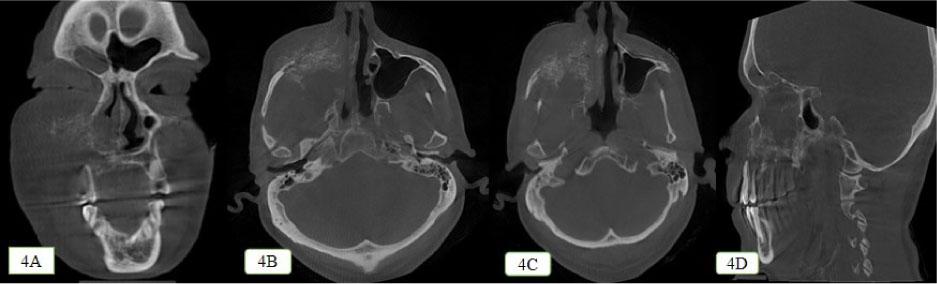 The unique radiographic pattern shown by adenocarcinoma as a result of destruction. 4A: Coronal section showing the mixed radiolucent radiopaque lesion causing destruction of nasal septum and giving rise to sunburst appearance. 4B and 4C: Axial section showing the mixed radiolucent radiopaque lesion showing destruction of nasal septum and zygoma giving the sunburst appearance. 4D: Sagittal section showing the sunburst pattern with respect to the floor of right maxillary sinus and nasal septum along with bone loss seen with respect to 13–18 region.