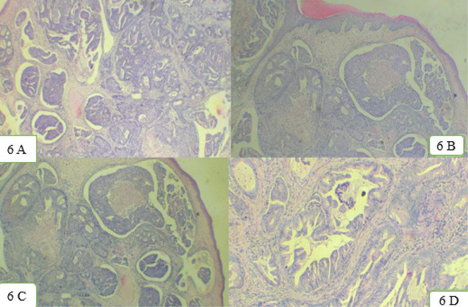 Histopathological images. 6A–6D: Pleomorphic tumor cells exhibited hyper chromatic vesicular nuclei and eosinophilic cytoplasm were arranged in glandular, cribriform, and papillary pattern. Glands with intraluminal necrosis were noted along with lymphovascular and perineural invasion.