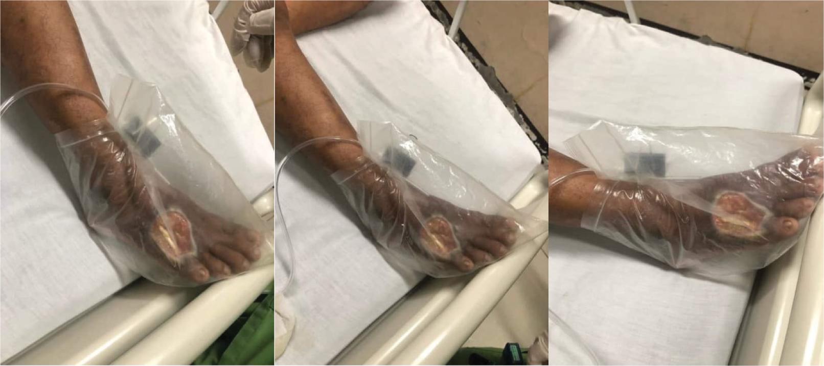 The actual application of topical oxygen therapy to 4 patients with diabetic foot ulcer.