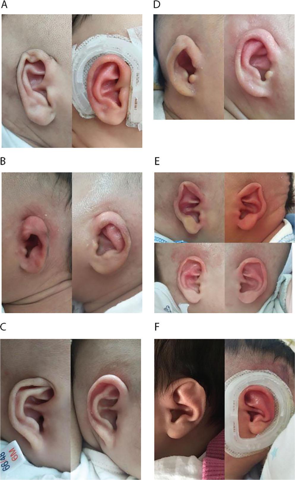 Treatment example of EarWell Infant Ear Correction System.
Born 30 days and after wearing for 17 days.Born 3 days and after wearing for 13 days.Born 32 days and after wearing for 28 days.Born 4 days and after wearing for 22 days.Born 8 day and after wearing for 55 days.Born 1 day and after wearing for 16 days.Note: These pictures list before treatment (left in each group) and after treatment (right in each group).