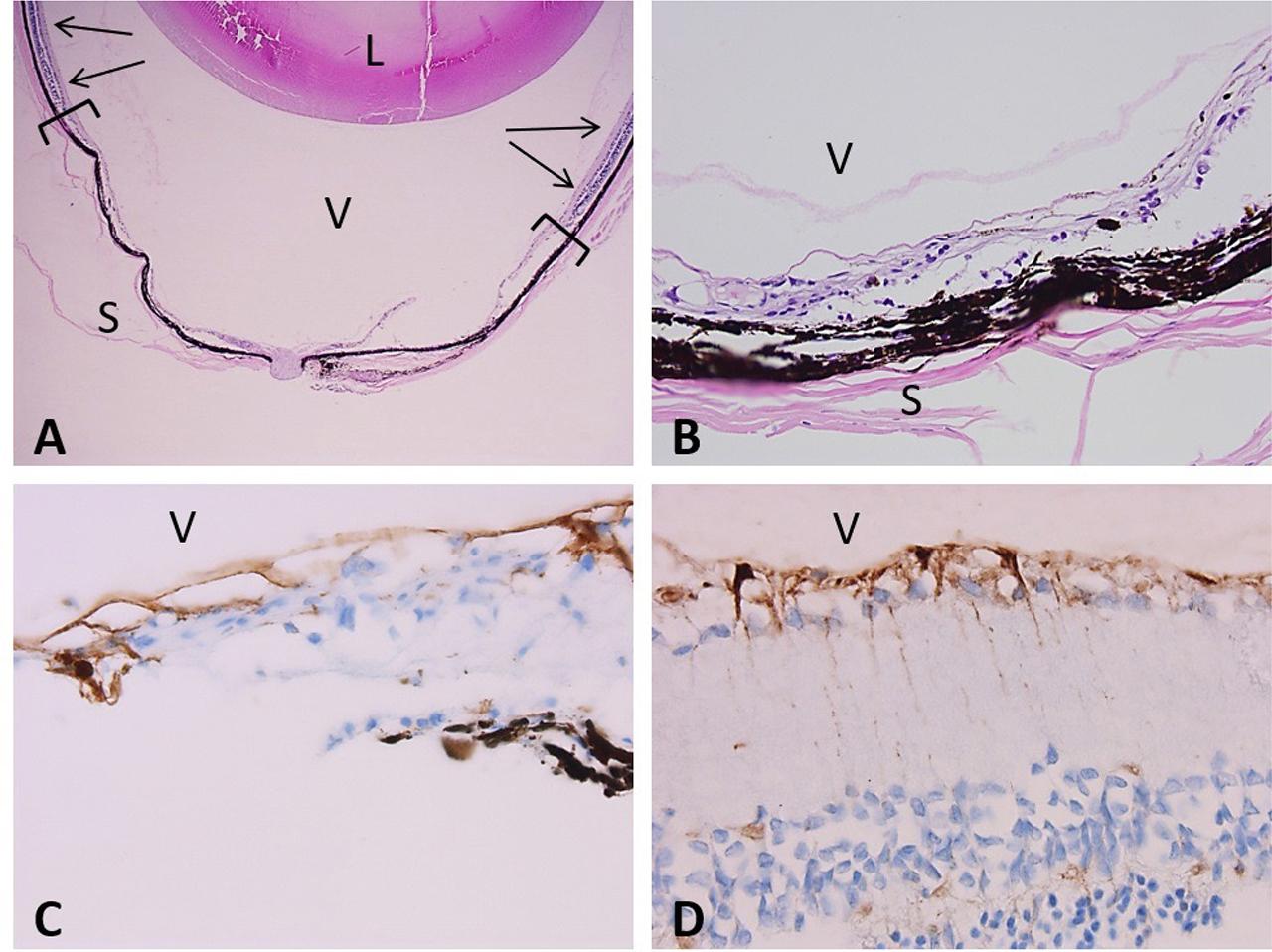 Histological examination of young female rat HS + 90 days recovery eye sections. (A) Low power magnification (2X) H&E stain shows residual peripheral normal retina (arrows) with a posterior thin retina forming the chorioretinal scar. The lens (L), vitreous (V) and sclera (S) are unremarkable. (B) High magnification (20X) H&E stain of a chorioretinal scar. (C) 40X magnification view of the retina in the scar immunostained with anti-GFAP antibody shows the irregular proliferation of glial cells in the inner layers (facing vitreous (V)). Immunohistochemistry, DAB chromogen, Glial fibrillary acidic protein antibody. (D) 40X magnification of the edge of the retinal scar immunostained with vimentin highlights the proliferating and activated Müller cells. Vitreous (V). Immunohistochemistry, DAB chromogen, vimentin antibody.