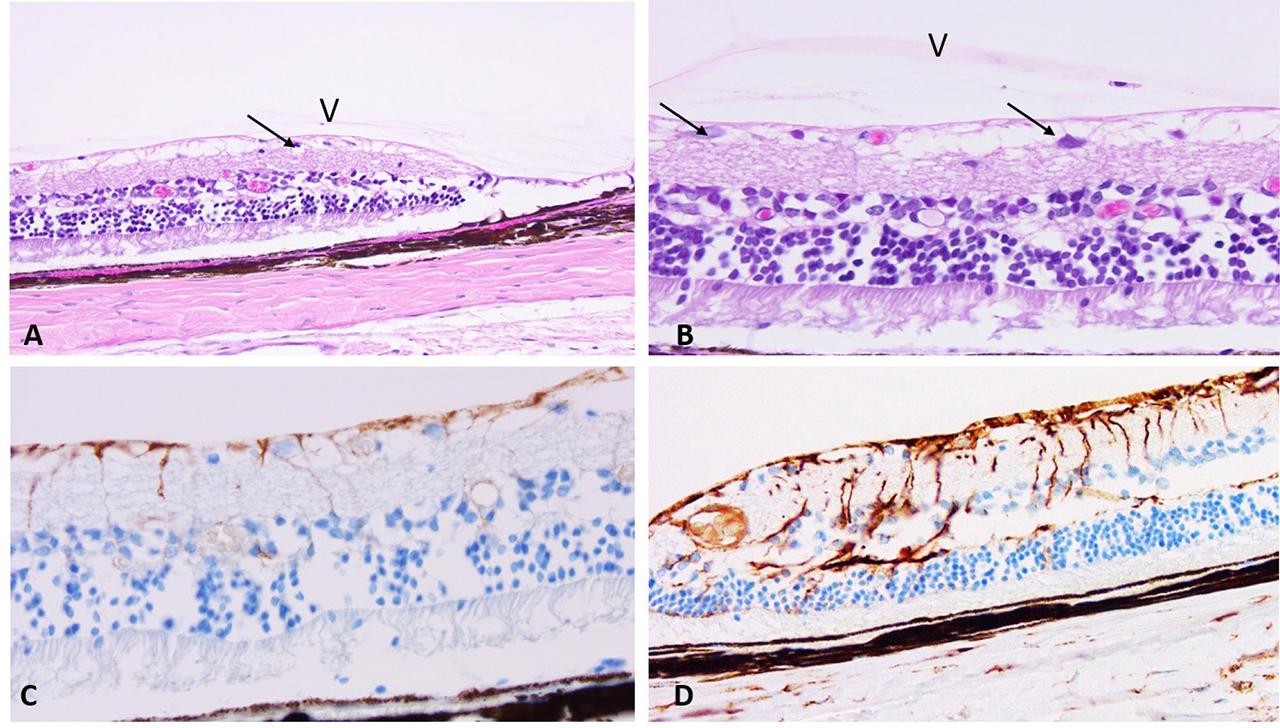 Histologic effects of HS in the rat retina of young male and female rats. (A) H&E staining at 20X magnification of peripheral retina showing few inner layer ganglion cells (arrow) and some condensation of vitreous (V). (B) Images of retina from YM at 180 days at equator is thicker but also shows some drop in ganglion cells (arrow) and condensed band of vitreous (V). H&E, original magnification 20X. (C) Immunohistochemistry example of GFAP staining of the glial and Muller cells in equatorial retina a male hind limb suspended (HS + 14 days recovery). Immunohistochemistry, DAB chromogen, GFAP antibody, 40X magnification. (D) Immunohistochemistry example of vimentin staining of Muller cells in the peripheral retina of a male hind limb suspended (HS+90 days recovery). Immunohistochemistry, DAB chromogen, vimentin antibody, 40X magnification.