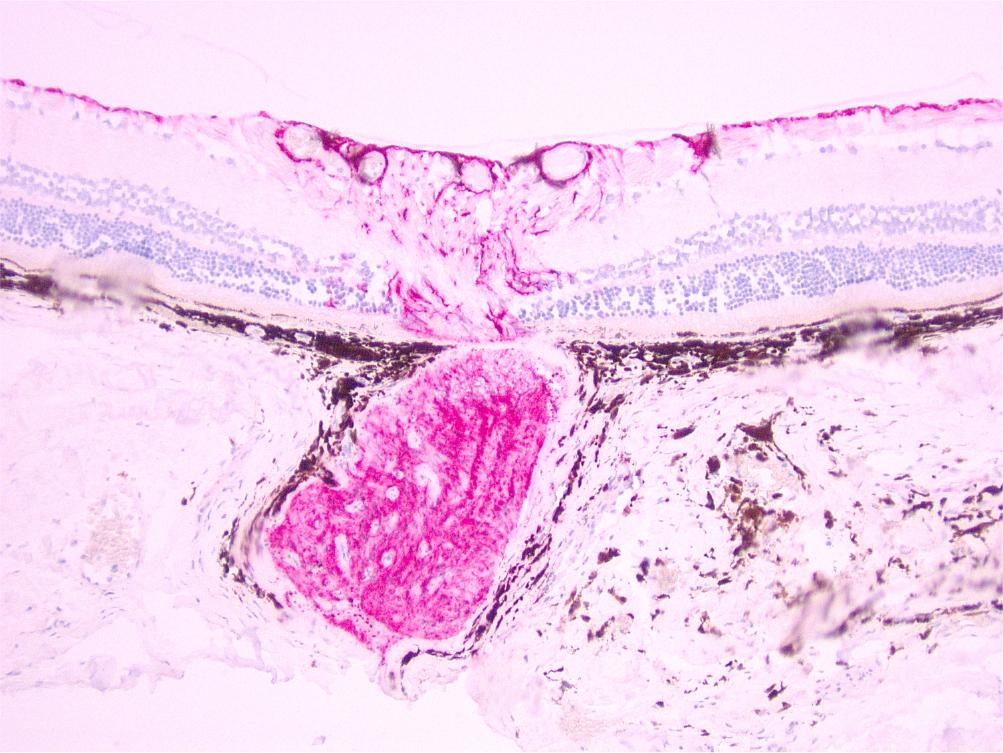 Histologic effects of HS in the rat optic nerve. (A) Image of a young male rat at 14 days HS at 40X magnification showing the posterior retina surrounding the optic nerve with intense immunoreactivity to GFAP antibody in the head of the nerve. Immunohistochemistry, Permanent Red chromogen, GFAP antibody.