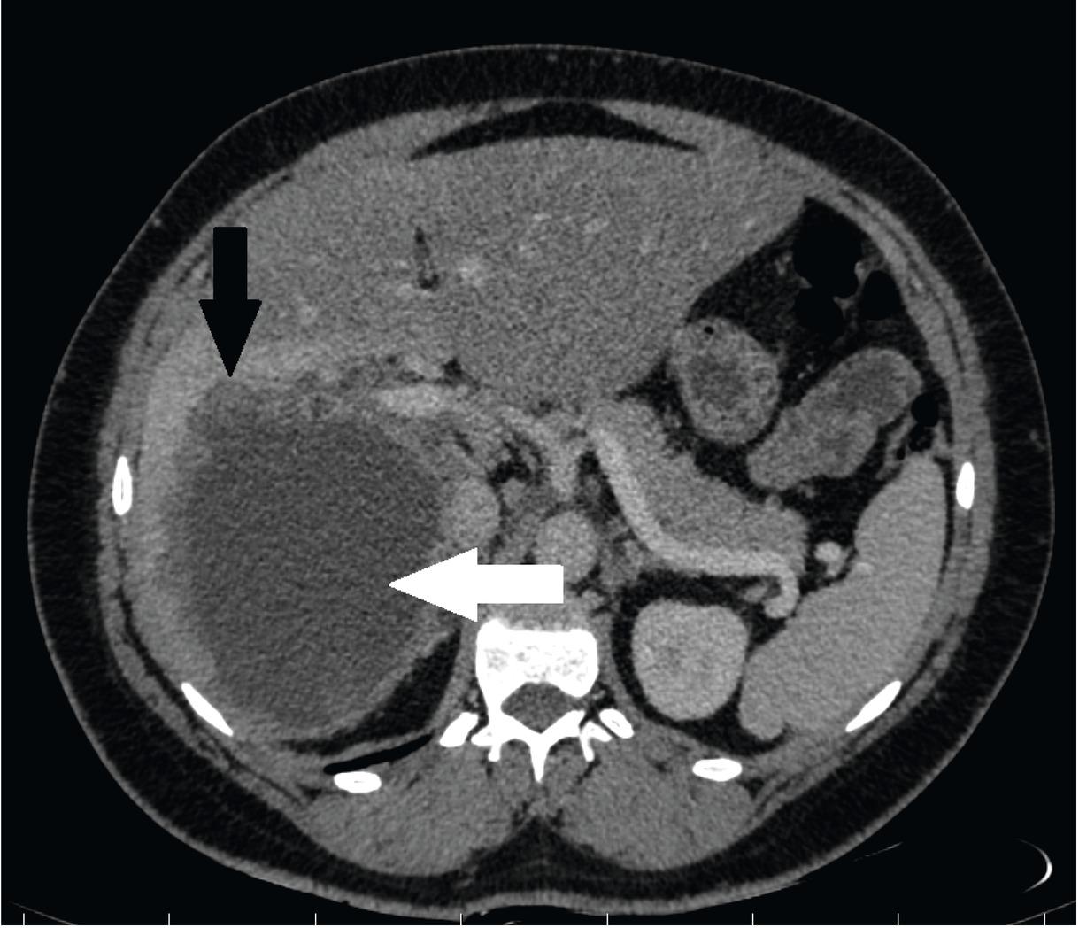 Computed tomography. Axial image of the abdomen. White arrow shows extensive infiltration of right liver lobe (white arrow) and smaller (daughter) cyst on its periphery (black arrow).
