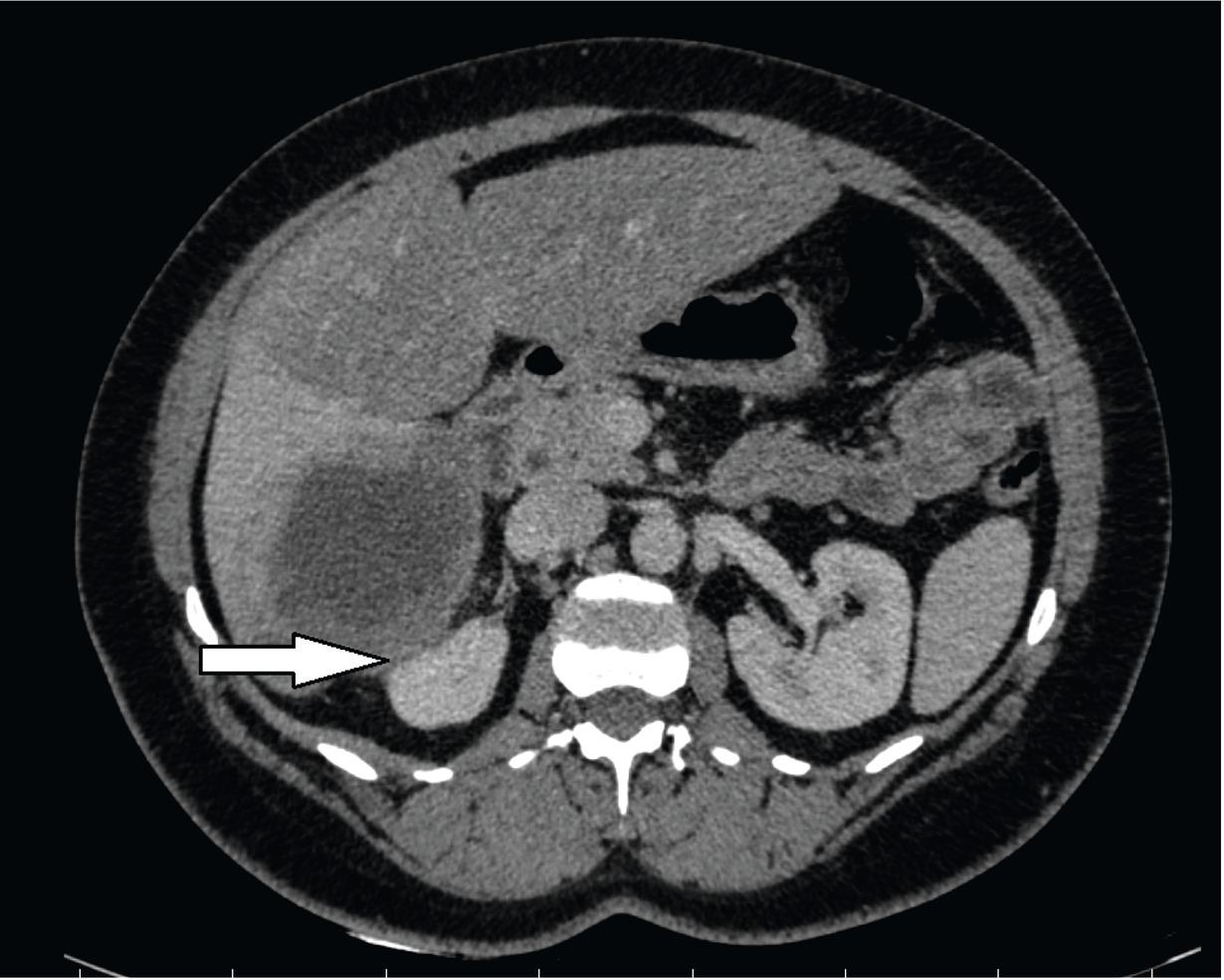 Computed tomography. Axial image of the abdomen. Infiltration of right adrenal gland (white arrow).