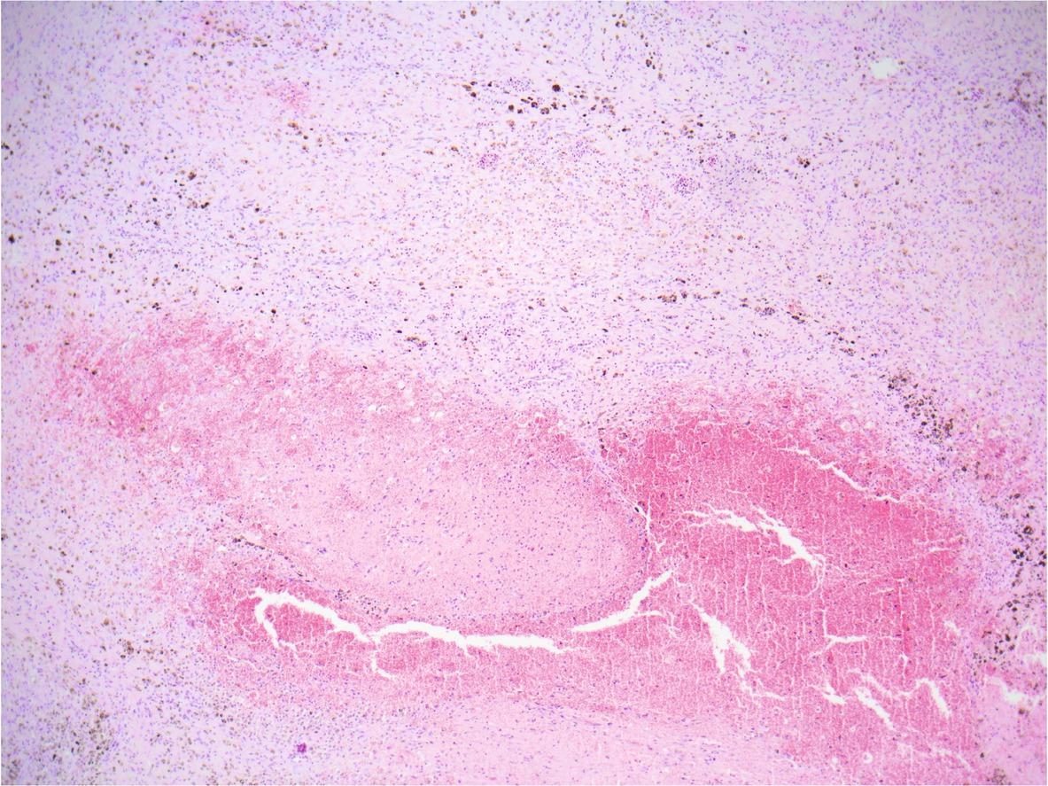 Lung, a segment of the migratory tract (channel) of F. magna. There is a mixture of fibrin, extravasated erythrocytes, and necrotic debris within the centre of the migratory tract (most of the lower half of the figure). Surrounding the centre (upper half of the figure) there is an elaborate immature fibrous tissue entrapping a few smaller and collapsed airways, and infiltrated by moderate numbers of lymphocytes, plasma cells, macrophages, and fewer neutrophils and eosinophils. Note numerous dark brown iron porphyrin pigment granules within the cytoplasm of the macrophages. Hematoxylin and eosin stain, 40X total magnification.