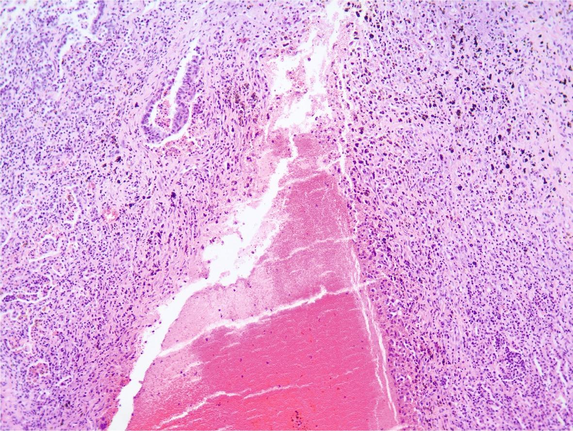 Lung, a segment of one smaller migratory tract (channel) of F. magna. Adjacent to lumen filled with erythrocytes there is a narrow layer of degenerated and necrotic inflammatory cells which is further bounded with an immature fibrous tissue of similar composition as described in figure 2. Note one medium-sized bronchiole and several collapsed and distorted airways which are filled with cellular and karyorrhectic debris and extravasated erythrocytes (left half of the figure). Hematoxylin and eosin stain, 100X total magnification.