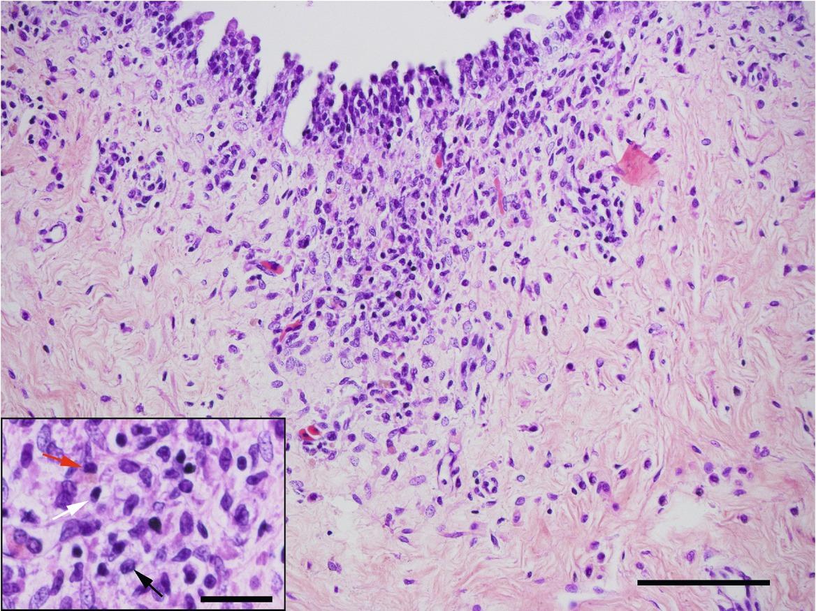 Marked inflammatory infiltrate in the lamina propria of the urinary vesicle composed of macrophages, lymphocytes and heterophiles (scale bar = 100 μm). Inset: macrophages (black arrow), rare lymphocytes (white arrow) and heterophiles (red arrow) (scale bar = 25 μm).