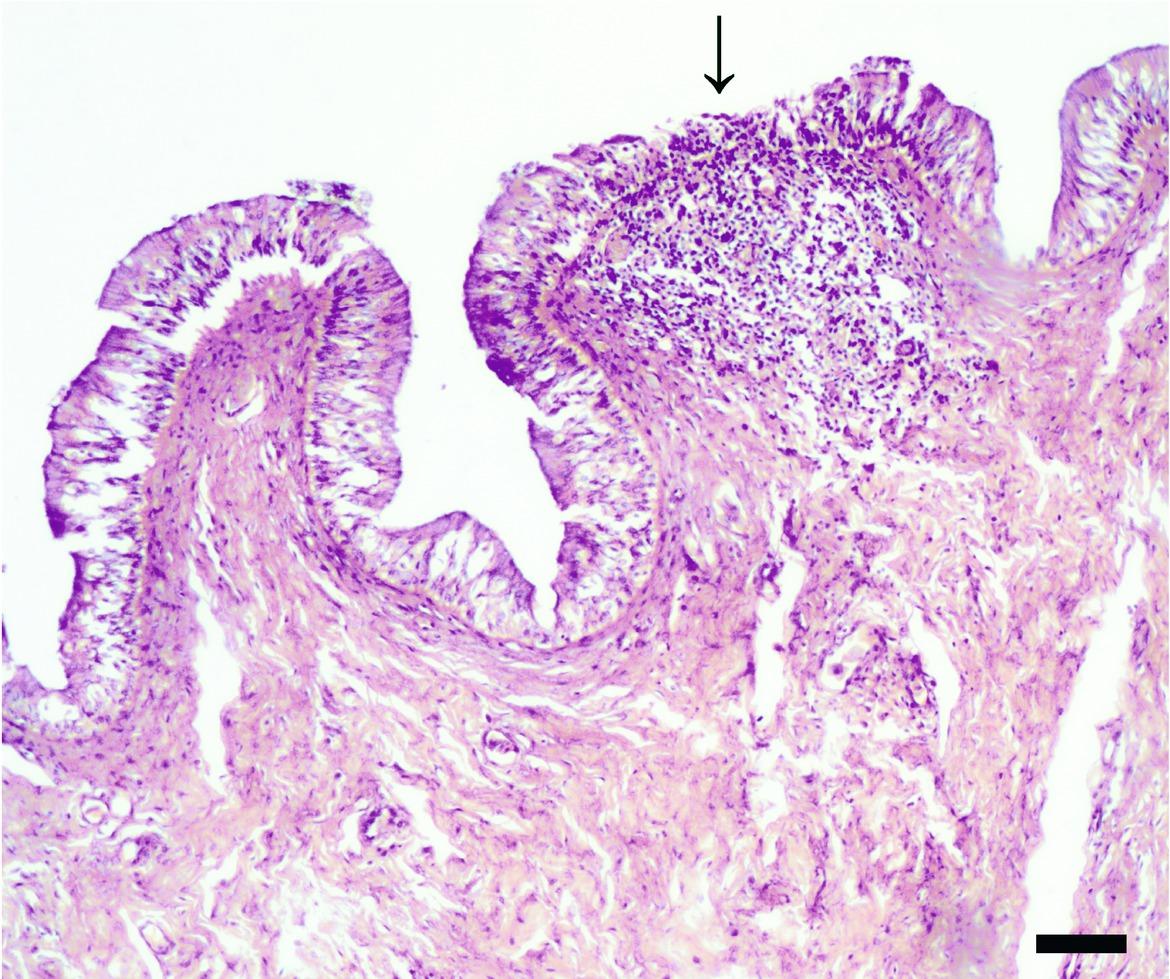 Focal area of discontinuity of the bladder epithelium (arrow), with replacement of the region by necrotic debris and mixed inflammatory infiltrate(scale bar = 50μm).