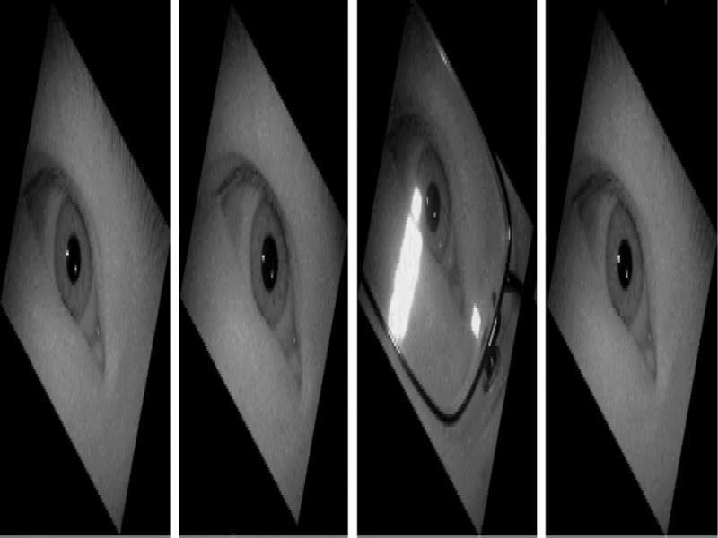 Treatment diagram of the sample rotated by 30° around the eye