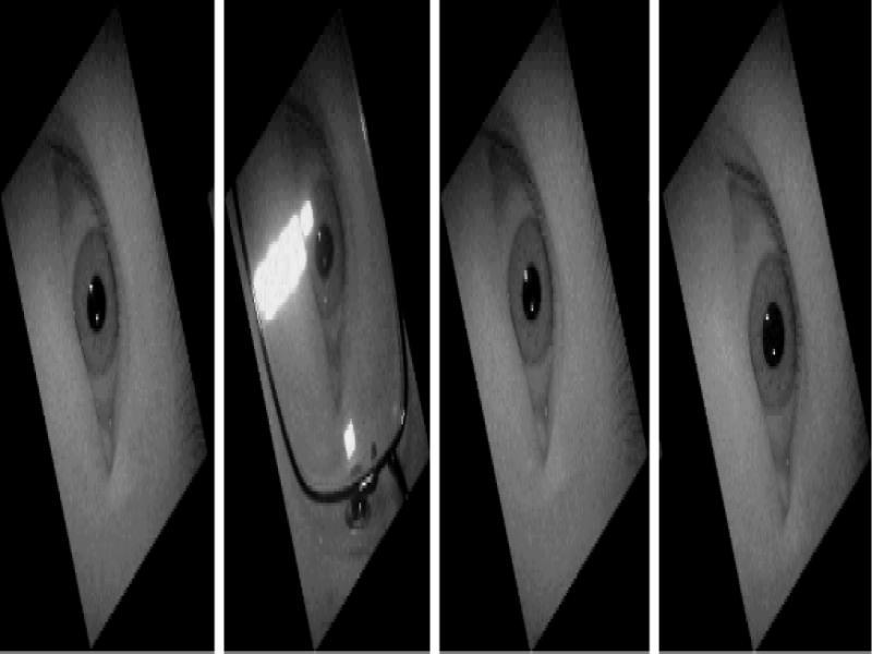 Treatment diagram of the sample rotated by 60°around the eye