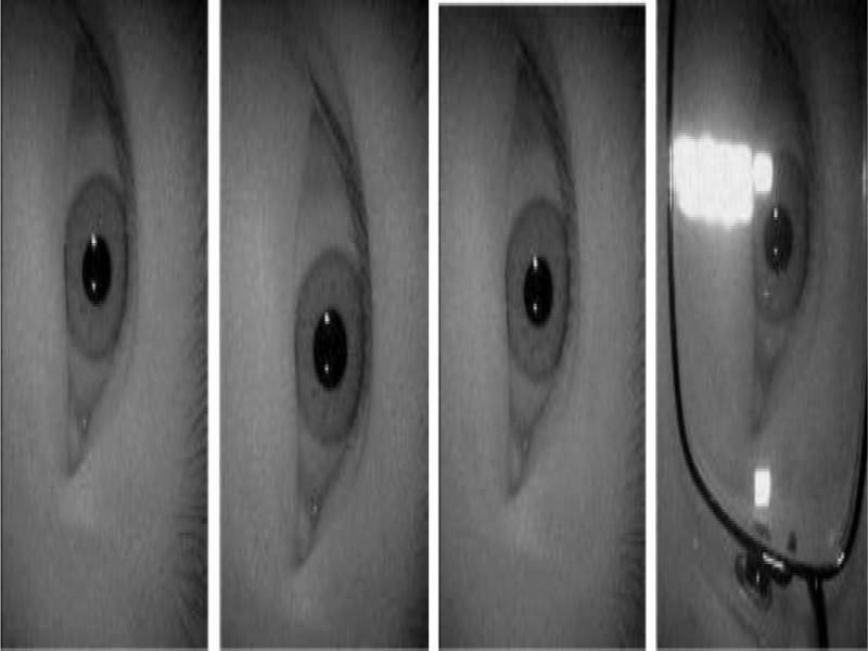 Treatment diagram of the sample rotated by 90°around the eye