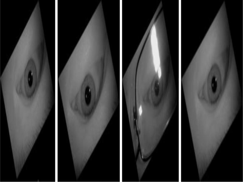 Treatment diagram of the sample rotated by 150°around the eye