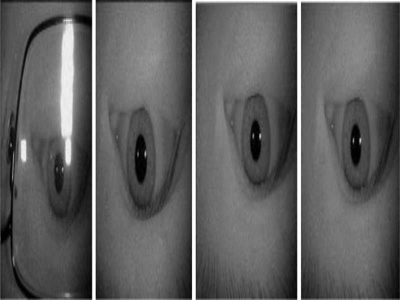 Treatment diagram of the sample rotated by 180°around the eye