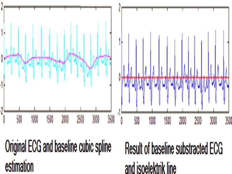 The ECG data before and after the cubic spline interpolation in order to remove the baseline wander.
