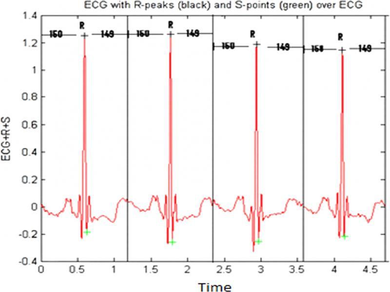 The individual beat segmentation.